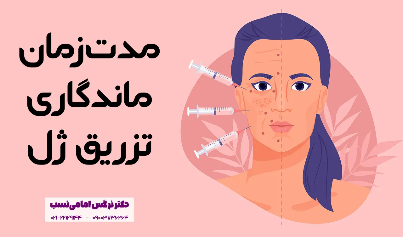 ماندگاری تزریق ژل به صورت چقدر است؟